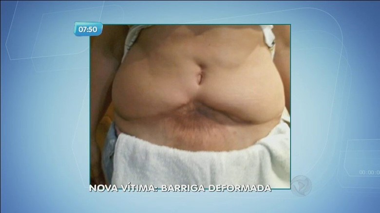 Com a divulgação da notícia da morte de uma mulher após uma cirurgia plástica em Praia Grande (SP), outra paciente do médico envolvido no caso resolveu quebrar o silêncio. Ela mostra como a barriga dela ficou deformada e acusa o cirurgião de erroNo R7 Play você pode assistir ao SP no Ar na
íntegra! Clique e experimente de graça!