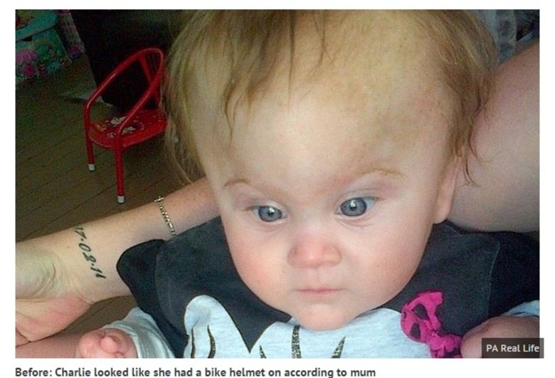 A cranioestenose é uma fusão prematura das
diferentes partes do crânio, impedindo-as de crescer, fazendo com que a cabeça
fique deformada. No caso de Charlie, os médicos ainda não sabem o que causou o
problema.

A menina inglesa nasceu seis semanas antes do prazo, em fevereiro de 2014,
porque estava ficando grande demais para a barriga de Jenna. Depois da cesárea,
ela permaneceu três semanas na UTI neonatal. Por causa do formato de sua
cabeça, os médicos fizeram exames para verificar se ela não tinha sofrido
qualquer tipo de dano neurológico. O diagnóstico da má-formação veio em junho
de 2014. A cirurgia, por sua vez, aconteceu em maio passado, e a família pode
retornar para casa seis dias depois

