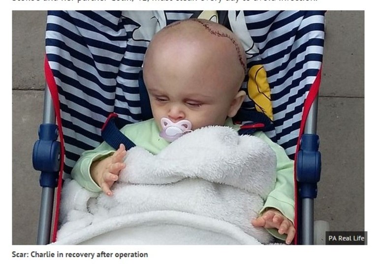 A mãe da menina, Jenna Stokoe, conta que a filha
passou pela operação quando tinha pouco mais de um ano. O procedimento durou
seis horas, e tinha como objetivo remoldar a cabeça de Charlie, que nasceu,
segundo Jenna, com o crânio “no formato de um capacete” por causa de uma
anomalia craniofacial chamada cranioestenose. Os médicos precisaram cortar a cabeça de Charlie de
orelha a orelha, quebrando e reconstruindo a parte frontal do crânio
