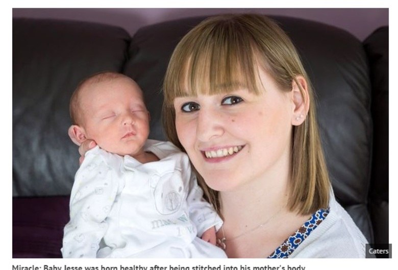 Nicola
Richards, de 27 anos, ficou em choque quando ouviu do seu obstetra que seu colo
do útero não era forte o suficiente para aguentar seu bebê, o que significava
que muito provavelmente ela teria um parto prematuro, e que seu filho corria o
risco de não sobreviver.

O
médico, então, ofereceu uma solução: com um único ponto, costurar Jesse ao
órgão da mãe.Às 33 semanas de gestação o menino nasceu, pesando 2,177 kg. Ele
passou duas semanas na UTI neonatal do Russells Hall Hospital, até finalmente
ser autorizado a voltar para casa com os pais