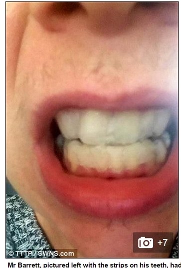 A reação ao composto químico começou a se manifestar cerca
de dois dias depois de Barret ter aplicado o produto em seus dentes, quando um
perigoso cisto começou a crescer embaixo de sua língua