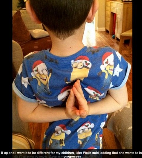 A mulher de 38 anos recebeu o diagnóstico de Síndrome de
Ehlers-Danlos (EDS, na sigla em inglês) há dois anos e conta que sofreu com
lesões a vida inteira, sem saber o que acontecia com seu corpo. 
— Já até quebrei o pulso ao levantar um copo de água.
Ninguém entendia o que acontecia com as minhas juntas. Meu joelho, então, já
até perdi a conta de quantas vezes desloquei. Hoje nem posso correr com as
crianças, muito menos segurá-los, porque meu corpo não aguenta