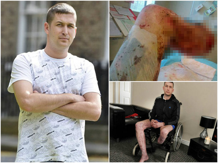 Craig Finn tinha acabado se me mudar para um apartamento novo e chamou alguns amigos para comemorar. Se mudou no tinha nem um ms. Na noite de comemorao, bebeu tanto que chegou a desmaiar. Foi quando James Gillibrand, seu 'melhor amigo', resolveu pregar uma pea e ateou fogo em suas pernas. Detalhe: Finn estava desmaiado! Curta a pgina oficial do Hora 7 no Facebook 