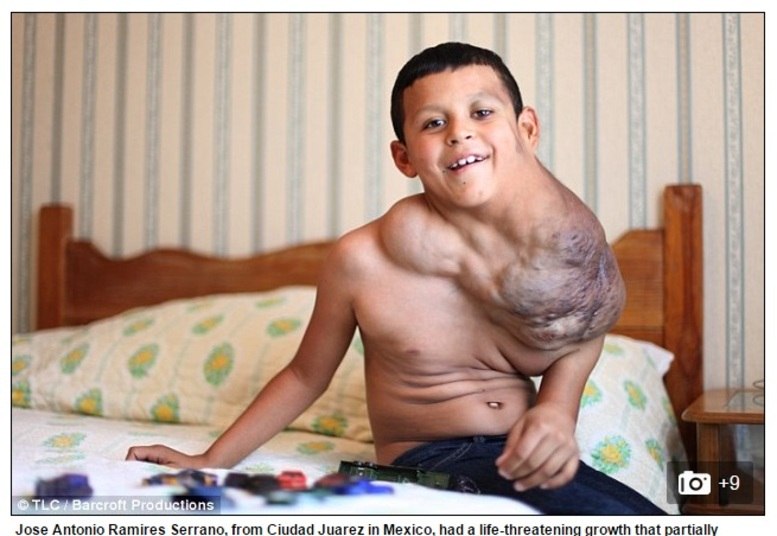 Por muito pouco, o garoto Jose Serrano, de 11 anos, não perdeu a batalha contra um
tumor gigante que tomava conta de seu pescoço, tórax e, principalmente, sua
traqueia. A salvação veio com uma cirurgia de 16 horas, que tirou a pressão que
o linfangioma exercia sobre seu coração e pulmões, e devolveu a ele a qualidade
de vida que Jose desconhecia desde que o tumor ganhou proporções descontroladas 
