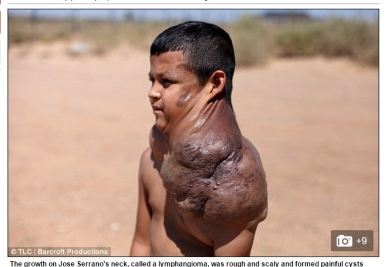 Por causa do tumor, que formava cistos dolorosos, Jose não podia andar
de bicicleta, nadar nem correr. Isso porque caso ele se machucasse, o
linfangioma poderia sangrar de maneira perigosa para sua saúde