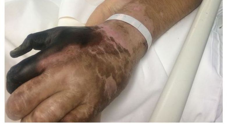 

— Eu ligo para o hospital todos os dias, mas eles insistem em dizer que
não têm vaga. Já consegui o avião para levá-lo pelo convênio,
mas o hospital não libera uma vaga 


