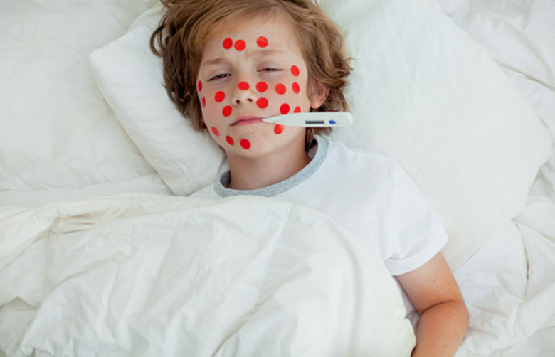 Catapora   Também chamada de varicela, a catapora é uma doença muito contagiosa causada por um vírus chamado Varicela Zoster. Essa doença é uma das mais comuns na infância, principalmente porque só se pega catapora uma vez. A principal característica é deixar o corpo coberto de pintinhas vermelhas, essas pintinhas começam no tronco da criança, espalhando-se rapidamente para o rosto, braços e pernas podendo se espalhar para dentro da boca, do nariz, das orelhas e de outros orifícios do corpo da criança. Depois de um tempo as pintinhas vermelhas se transformam em pequenas bolhas de água que, quando começam a cicatrizar de 4 a 5 dias, formam ‘casquinhas’ e caem. Quando estas pequenas feridas são coçadas infeccionam e deixam na pele cicatrizes permanentes, isto é, não somem jamais. Além disso, a criança tem febre alta, bastante coceira na pele, cansaço, cefaléia e perda de apetite.    