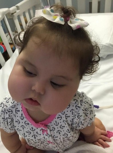 Entre os sinais gerais da doença estão a retenção urinária,
dilatação da bexiga, barriga inchada, vômitos, prisão de ventre, músculos
flácidos na região do abdômen, inchaço do rim e obstrução do intestino. 
Além do comprometimento do intestino, Ibrahim também diz que
há alteração na bexiga, que acaba ficando muito dilatada, o intestino delgado
fica inchado e o grosso retraído.

— Essa criança não vai urinar direito, e tem dilatação do
estômago, que causa vômito, prisão de ventre, a barriga fica flácida, o rim
acaba inchando e o intestino não funciona. É uma obstrução funcional