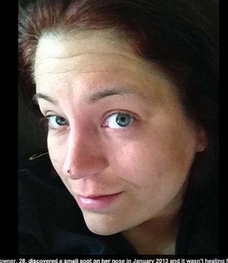 Em janeiro de 2013, Bree notou que a mancha no rosto estava
aumentando, mas os médicos disseram que ela não precisava se importar. Dois anos
depois, o tumor já havia crescido e ela descobriu que tinha câncer de pele 