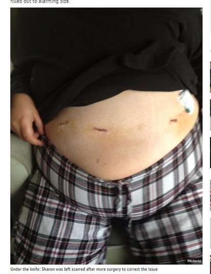 Alison
foi operada em caráter de emergência em outubro de 2010, e removeu um abcesso de
uma de suas trompas. Logo depois, ela desenvolveu três nódulos no estômago, que
rapidamente cresceram até atingirem um tamanho alarmante.

— Meu
corpo estava lutando muito para se recuperar. O médico me explicou que aquilo
eram hérnias, e que elas apareceram como resultado do meu sobrepeso. Meu peso
estava forçando as paredes internas do meu abdômen. Eu estava apavorada