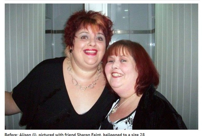 O abdômen
de Alison ficou tão distendido que pessoas na rua perguntavam a ela se ela
estava grávida. 

— Além
de doer muito, as hérnias me causaram muita vergonha. Estranhos se cutucavam
enquanto eu passava por eles, me apontavam, olhavam fixo para o meu estômago.
Alguns até me paravam para saber quando era a data do parto. A coisa ficou tão
feia que eu cheguei a pensar em usar uma camiseta escrito “é uma hérnia, e não
um bebê”