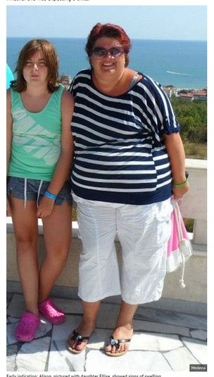 A filha de Alison, Ellise, de 15 anos, contou ao jornal Mirror
que assistiu por anos a fio o crescimento sem pausa do abdômen da mãe, que
sempre gostou de comer grandes quantidades de alimentos. Depois da “explosão”, Alison precisou passar por uma cirurgia,
que acabou deixando-a com uma grave pneumonia. Por causa do problema, ela
passou três semanas em coma induzido.

— Eu era uma comedora compulsiva, por problemas emocionais. Eu
comia quando precisava me sentir bem, quando estava feliz, e também quando estava
triste. Eu era viciada em carboidratos e amava pães, batata frita e macarrão.
Quando Ellise cresceu o suficiente para correr pela casa, eu estava
perigosamente grande e incapaz de cuidar dela. Procurei dois nutricionistas e
tentei até hipnose, mas nada funcionou. Só fiquei ainda mais gorda