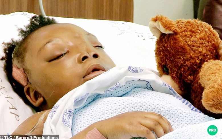 Os médicos explicaram que a
cabeça da menina sofre de uma deformação conhecida como encefalocele, que
separava os dois lados da cabeça. Segundo os especialistas, havia um buraco de
13 centímetros entre o cérebro e a boca de Ndola