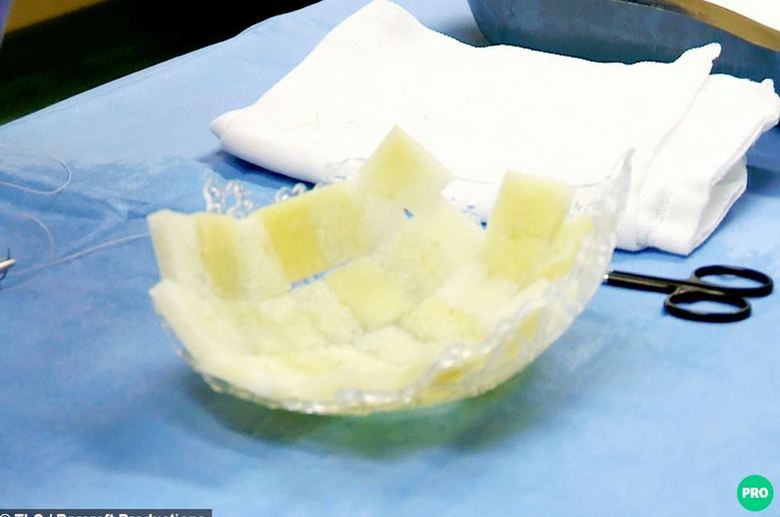 Depois dessa operação, a menina
passou a usar um capacete, para sustentar a cabeça. Os pais precisavam tomar
cuidado extremo, para que nada atingisse a menina e prejudicasse o desenvolvimento
do tratamento