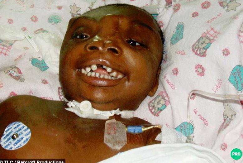 Ela nasceu em Ndola, na Zambia,
e ainda não pôde ir à escola, e somente depois de muito tempo de recuperação é
que os médicos poderão liberá-la para brincar com outras crianças, já que seu
organismo é extremamente sensível a qualquer tipo de infecção