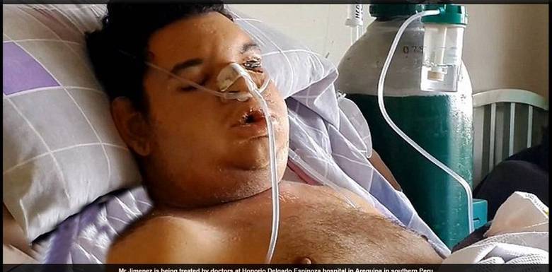 Os pais de
Orlando estão pagando uma média de R$ 820 por dia em tratamentos de diálise,
transfusão e medicamentos. Eles criaram uma página no Facebook em que pedem ajuda
financeira para continuar cuidando do filho doente.


Felicitas
Maria Jimenez, mãe do rapaz, conta que a aranha caiu em cima de Orlando, e logo
mordeu seu lóbulo esquerdo. Em poucos minutos, segundo ela explicou em
entrevista ao jornal Daily Mail, seu corpo entrou em colapso, e ele foi levado
às pressas a uma unidade de saúde local para receber o antídoto