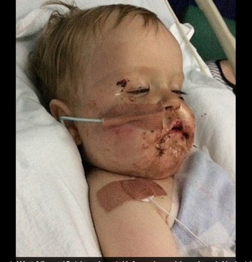 A mãe do menino, Deanne, fica o tempo todo ao lado do
pequeno e comemorou o primeiro aniversario do filho dentro do hospital