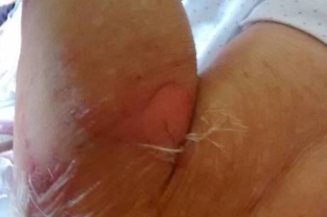 A família não entende como a paciente foi queimada no hospital