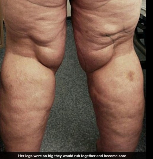 De acordo com o site Daily Mail desta quarta-feira (4), Faye
lutou contra o peso por 30 anos, chegando a pesar 146 kg. Porém, ela sempre
teve dificuldades em emagrecer as pernas