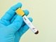 O exame PSA (feito pela análise do sangue) é importante para diagnosticar o câncer de próstata? O
PSA é extremamente sensível para detecção do câncer da próstata. A maioria dos
casos é diagnosticada por meio dele.— A maioria
dos estudos recomenda que os homens realizem ambos [os exames] 