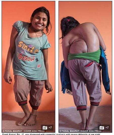 A adolescente indiana Preeti Kumari Rai recebeu o
diagnóstico de escoliose congênita com deformidade severa quando tinha apenas oito
anos. 
Hoje, aos 17 anos, ela teve que tomar uma decisão difícil:
permanecer com a condição ou tentar uma arriscada cirurgia, com possibilidade
de morte e de paralisia.

Veja mais imagens a seguir