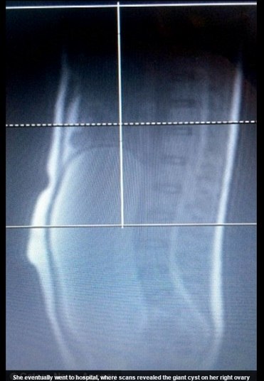 No hospital, Olivia realizou exames de sangue, urina e gravidez. A
suspeita principal de início era de que ela estivesse com apendicite. 

— Quando eu descobri que era câncer, eu entrei em choque. Nunca imaginei
que uma coisa dessas acontecesse com alguém de 17 anos. O cisto era tão imenso
que eu achei que explodiria como um balão a qualquer momento. Além disso, ainda
comecei a ficar em pânico de que o câncer se espalhasse pelo meu corpo todo