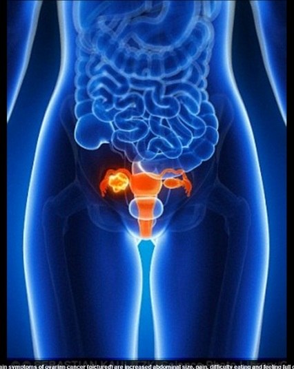 O oncologista responsável pelo caso da jovem, Richard Hutson, disse que
Olivia teve muita sorte.

— O
tumor não se espalhou para os seios, nem o cisto se rompeu. Havia quatro litros
de líquido dentro do cisto, e tudo foi removido através de uma pequena incisão.
Além disso, sua fertilidade não foi afetada, e ela terá as mesmas chances de
ter filhos que uma outra mulher que não tenha passado por este problemaConfira o R7 Play e assista à programação da Record na íntegra