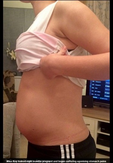 Olivia Key, agora com 18 anos, treina para seu uma técnica esportiva.
Ela conta como foi finalmente descobrir o que deixava sua barriga inchada e
dolorida.

— Vi que meu corpo ficou inchado, mas achei que era uma mudança normal da idade.
Mas aí comecei a ter dores horrorosas, e vi que precisaria procurar ajuda para
ver do que se tratava. Tinha dias em que eu nem conseguia sair da cama. Quando saíram
os resultados, todos ficaram chocados. Sou pequena, então, para que minha
barriga ficasse daquele tamanho, só mesmo se eu estivesse grávida