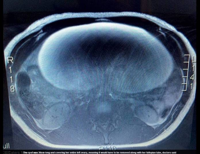 — Por sorte, os cirurgiões retiraram tudo antes que o câncer fosse para
outros lugares. Nunca passou pela minha cabeça que eu poderia ter câncer. Você
nunca imagina que vai acontecer com você