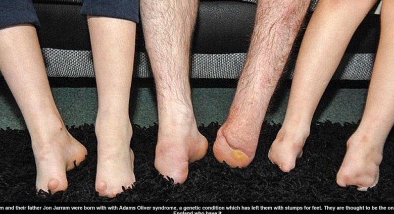 De acordo com informações do Daily Mail, Kian, de 11 anos, e Callum Jarram, de sete anos, nasceram com uma síndrome raríssima em que os dedos dos pés e das mãos não crescem normalmente