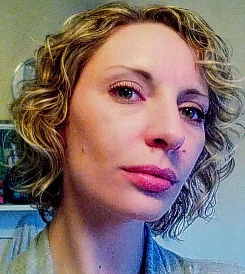 Na foto, Tammy aparece antes da doença, contraída há dois anos. Hemorragias também são comuns e podem levar à necrose e isquemia de membros, sendo necessária a amputação