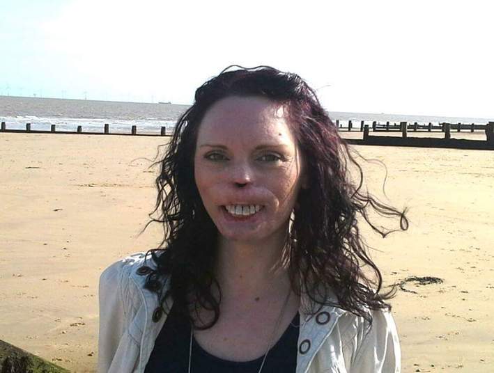 A doença se baseia em uma espécie de envenenamento do sangue, resultante de uma infecção provocada pela meningite, que é a inflamação da meninge (rede de membranas que protegem o sistema nervoso central). Entre possíveis sequelas estão a pericardite, artrite e insuficiência renal