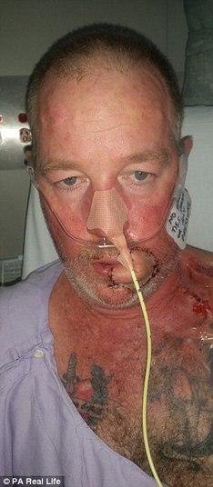 Antes de entrar pela segunda vez em uma mesa de operação, ele foi tomado de desespero.— Meu aspecto era tão ruim que temi que pudesse me matar 