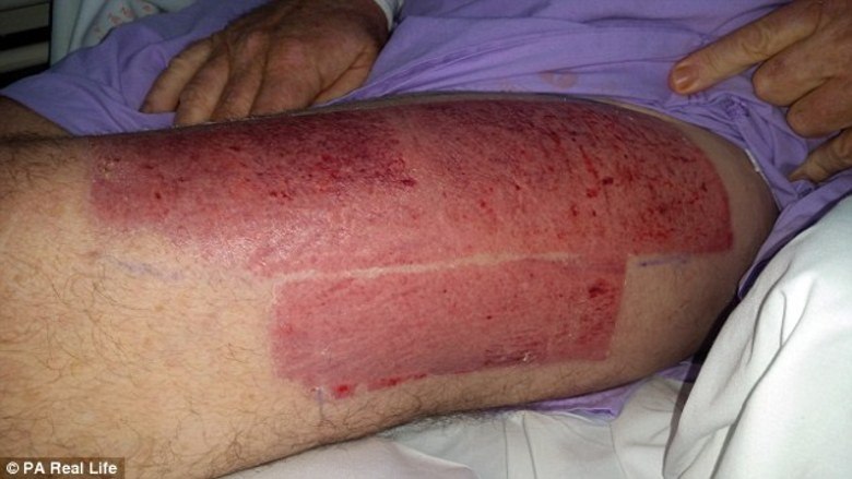 Apoio não lhe tem faltado. Além da família, os médicos se desdobraram em buscar soluções. E reconstruíram parcialmente sua mandíbula com parte da fíbula (osso da perna), por meio de exertos da pele da perna na face, para restaurar a boca