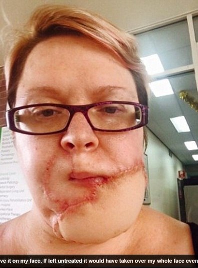 
Jodie Dominy, 41 anos, passou por um grande sofrimento. Ela
precisou retirar um câncer que se desenvolvei em seu rosto e acabou perdendo o
queixo e lábio inferior