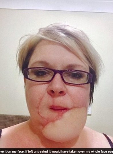 Anos se passaram até que o tumor começou a crescer e provocar
dores. Então, ela novamente procurou um especialista e descobriu que, na
realidade, ela sofria com um tipo raríssimo de câncer chamado dermatofibrossarcoma
protuberan