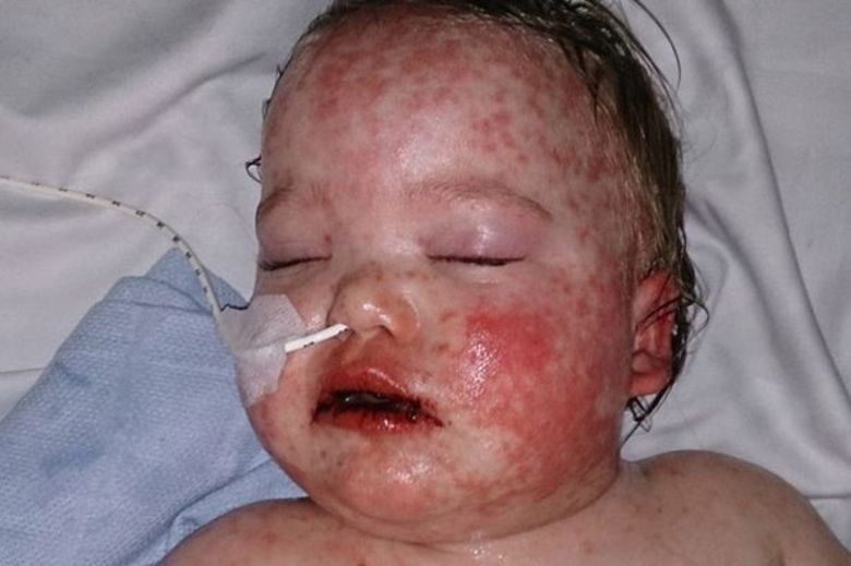 Danielle conta que ficou horrorizada quanto a pele do filho começou a empolar. —  Seus lábios ficaram pretos e uma erupção vermelha cobria todo o seu corpo. Não tínhamos ideia do que estava acontecendo com ele, mas nós sabíamos que era uma ameaça à vida. A boca dele estava coberta de sangue, foi assustador