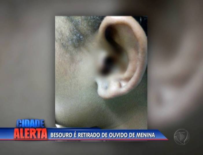 Preocupada com a situação, a madrinha da criança pagou R$ 300 por uma consulta em uma clínica particular, onde o inseto foi removido. O besouro ainda estava vivo e, de acordo com o médico, caso demorasse um pouco mais, poderia ter comprometido a audição da menina