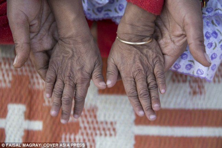 Trata-se de uma condição genética rara que faz com que o corpo de uma criança pareça ter uma idade muito além do que deveria. Atinge uma média de uma criança a cada 4 milhões de nascimentos