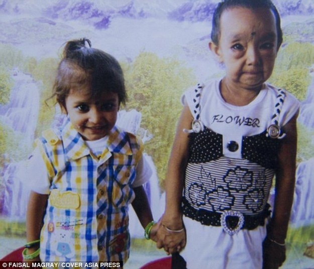 Os médicos diagnosticaram os casos como Progeria, também conhecida como HGPS (síndrome de Hutchinson-Gilford Progeria). No cinema, o filme 'O estranho caso de Benjamin Button', com Brad Pitt, apresentou situação semelhante