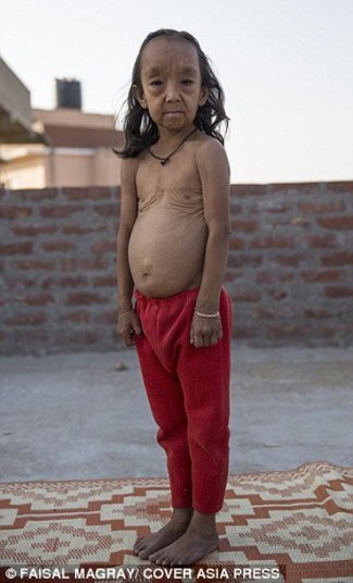 O sonho deles era um dia poder parecer com qualquer criança na rua. Mas os médicos dizem que tal situação não tem cura