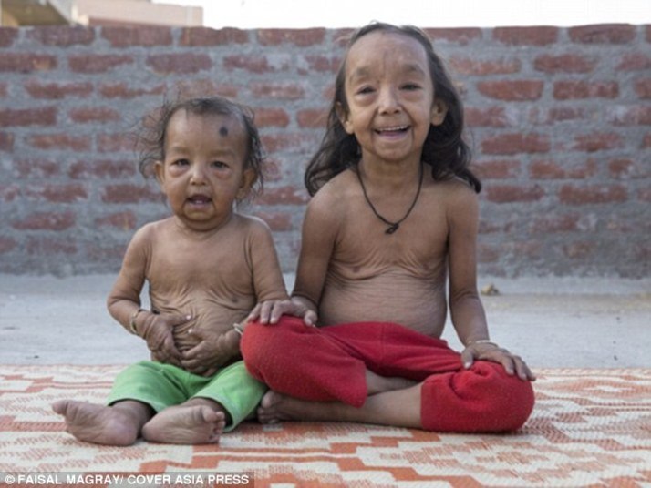 Uma doença rara deixou o menino Keshav Kumar, de 18 meses, e sua irmã, Anjali Kumari, de sete anos, com aparência de idosos
