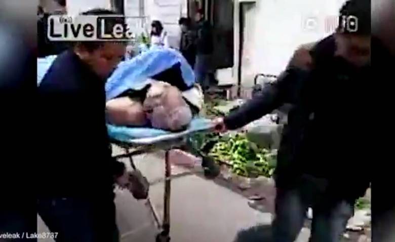 A dupla teria sido levada para um hospital para ser separada cirurgicamente. Em seguida, o homem seria levado para o necrotério