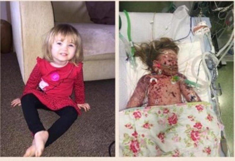 Com o passar dos dias, a saúde de Faye melhorou. No entanto, ela sofreu uma complicação comum associada à meningite B — uma infecção geral do organismo, ou sepse. Quando a condição foi detectada, os pais tiveram que aceitar que a perna e o braço de sua filha fossem amputados, mas a medida não surtiu efeito