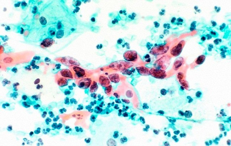 Contudo, a doença progrediu mais rápido do que se era esperado, e Jade faleceu na última quinta-feira (11), em casa, rodeada de familiares e amigos.  Antes de morrer, a jovem lançou uma petição online para incentivar outras garotas a realizarem o 'papa nicolau', mesmo com a pouca idade. O exame não tem como função diagnosticar o câncer, no entanto, ele identifica anormalidades que têm potencial para se tornarem um câncer futuramente. À medida em que a doença se agravava, Jade sempre dizia que se tivesse feito o exame antes, teria chances de sobreviver. — Eu acredito que se a possibilidade de câncer tivesse sido descoberta antes, quando eu tinha uns 20 anos de idade, as células cancerosas poderiam ter sido destruídas e eu teria chances de me curar 