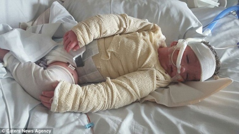 Quando o pequeno Joel chegou ao hospital, com queimaduras de terceiro grau e olhos muito inchados, os médicos logo perceberam que ele, na verdade, sofria de uma doença rara chamada síndrome de Stevens Johnson — a condição é potencialmente fatal e normalmente é provocada por uma reação a medicamentos ou infecções