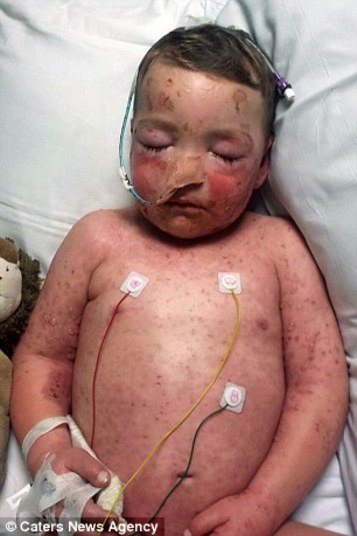 A criança foi levada às pressas para a ala de cuidados intensivos do hospital e os médicos tiveram que informar Tammy sobre a gravidade da doença: uma em cada cinco vítimas da Síndrome de Stevens Johnson não sobrevive. Desesperada, a mãe se sentiu impotente como nunca:— Só me restava esperar e rezar para que ele sobrevivesse 