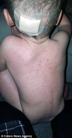 Depois de passar por um tratamento intensivo de cinco dias, Joel foi encaminhado à área de ventilação e depois transferido para a unidade de queimados do hospital. Lá, o menino foi envolvido em bandagens — para prevenir infecções — e submetido a uma cirurgia de oito horas para retirar a pele morta. — Joel ficou irreconhecível. Eu estava com medo de tirar as bandagens que enfaixavam seu corpo inchado. Mas, graças a toda a equipe do hospital, pude ter meu filho de volta e com saúde depois de nove semanas