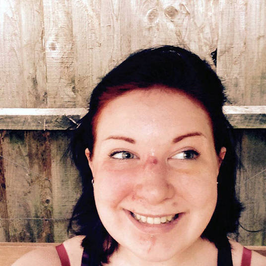 Em entrevista ao jornal britânico The Sun, ela detalhou o acidente que a deixou com a boca desfigurada. — Meu namorado e eu tinhamos ido a uma piscina e estávamos voltando de bicicleta. Então, nossas rodas dianteiras se tocaram, e isso foi tudo o que precisou para me arremessar para a frente. Voei direto por cima do guidão e bati com a cara no chão