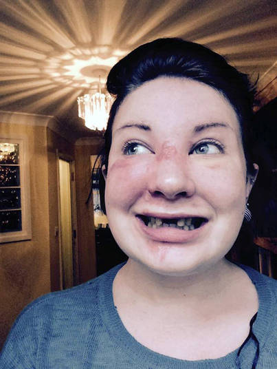 Por enquanto, a designer gráfica está usando dentaduras. Mas, em breve, ela passará por uma operação para reconstruir sua boca com ossos de vaca. E também colocará implantes de dente permanentes